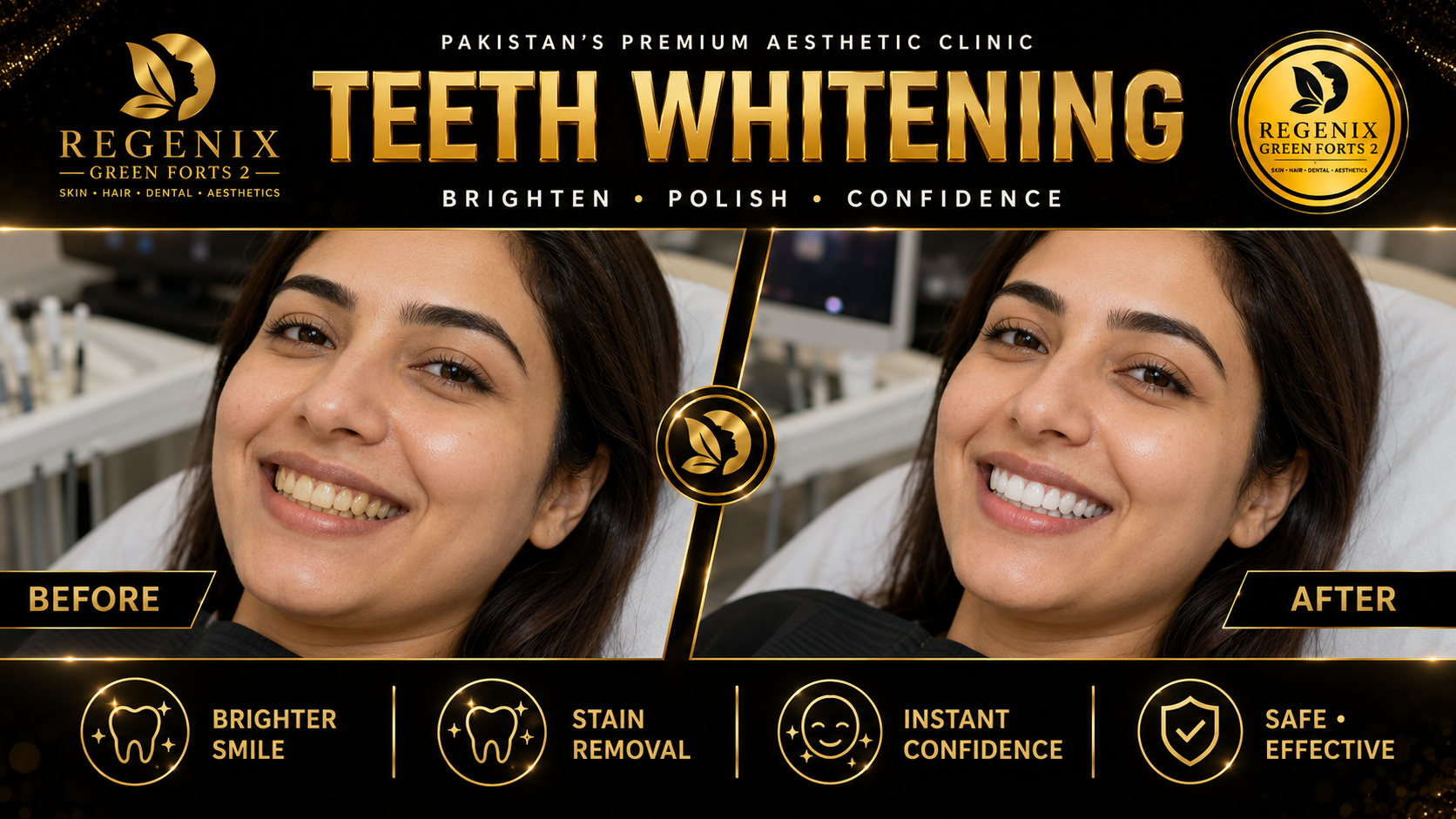 Teeth Whitening visual reference