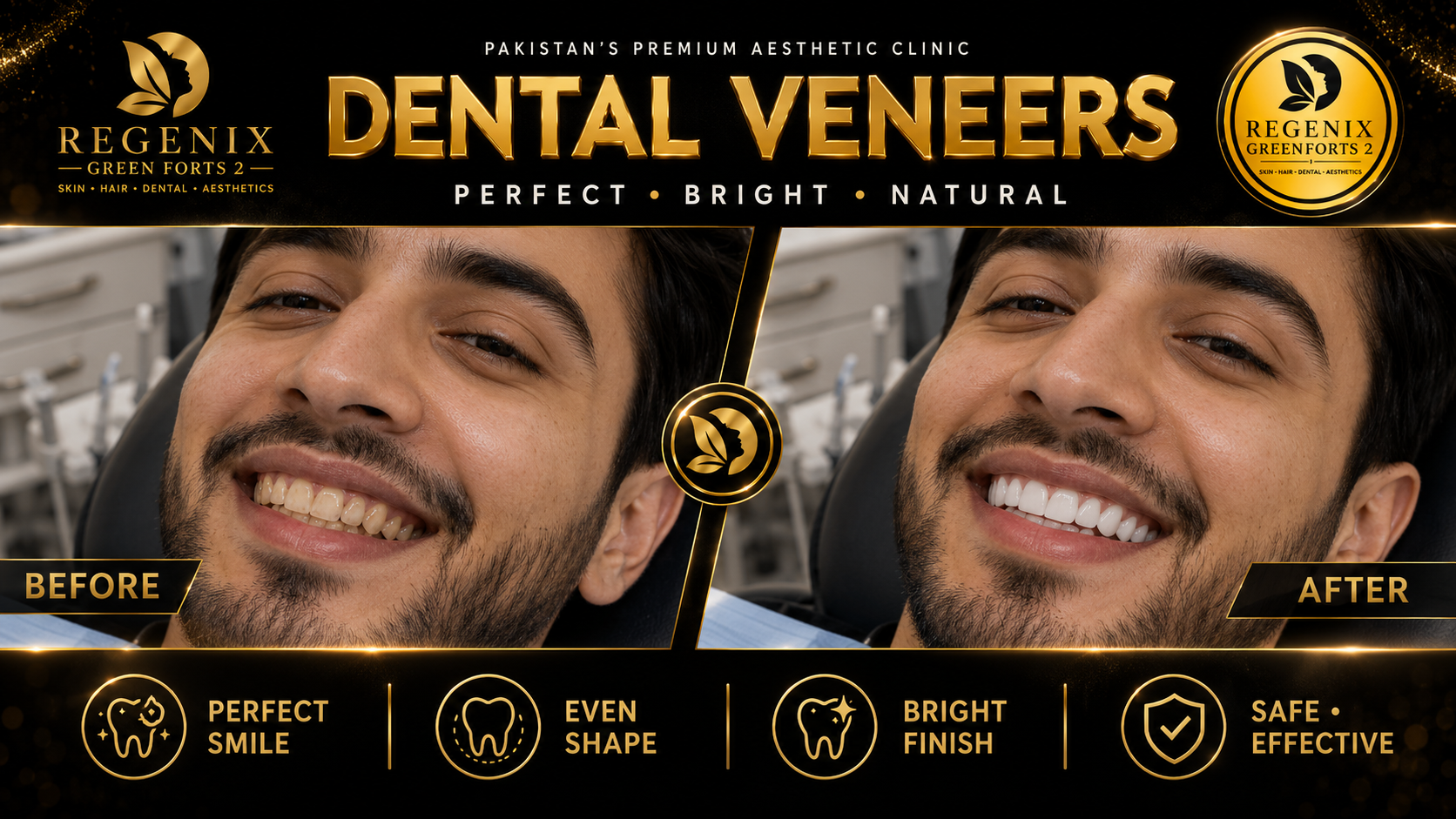 Dental Veneers visual reference