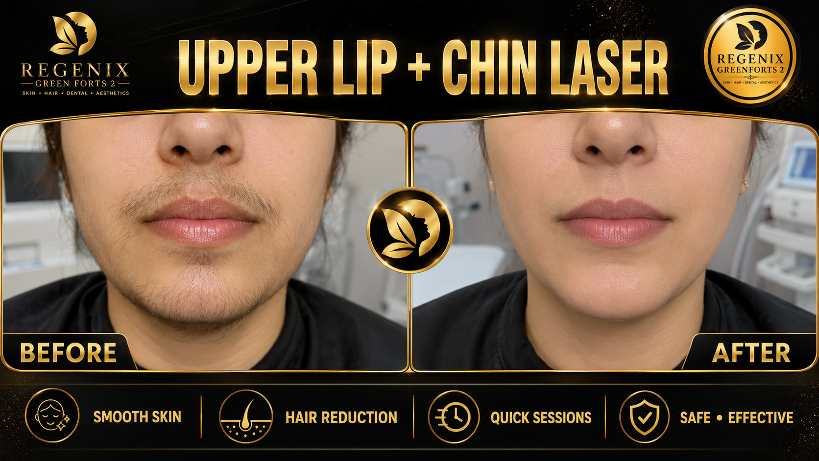 Upper Lip & Chin Laser