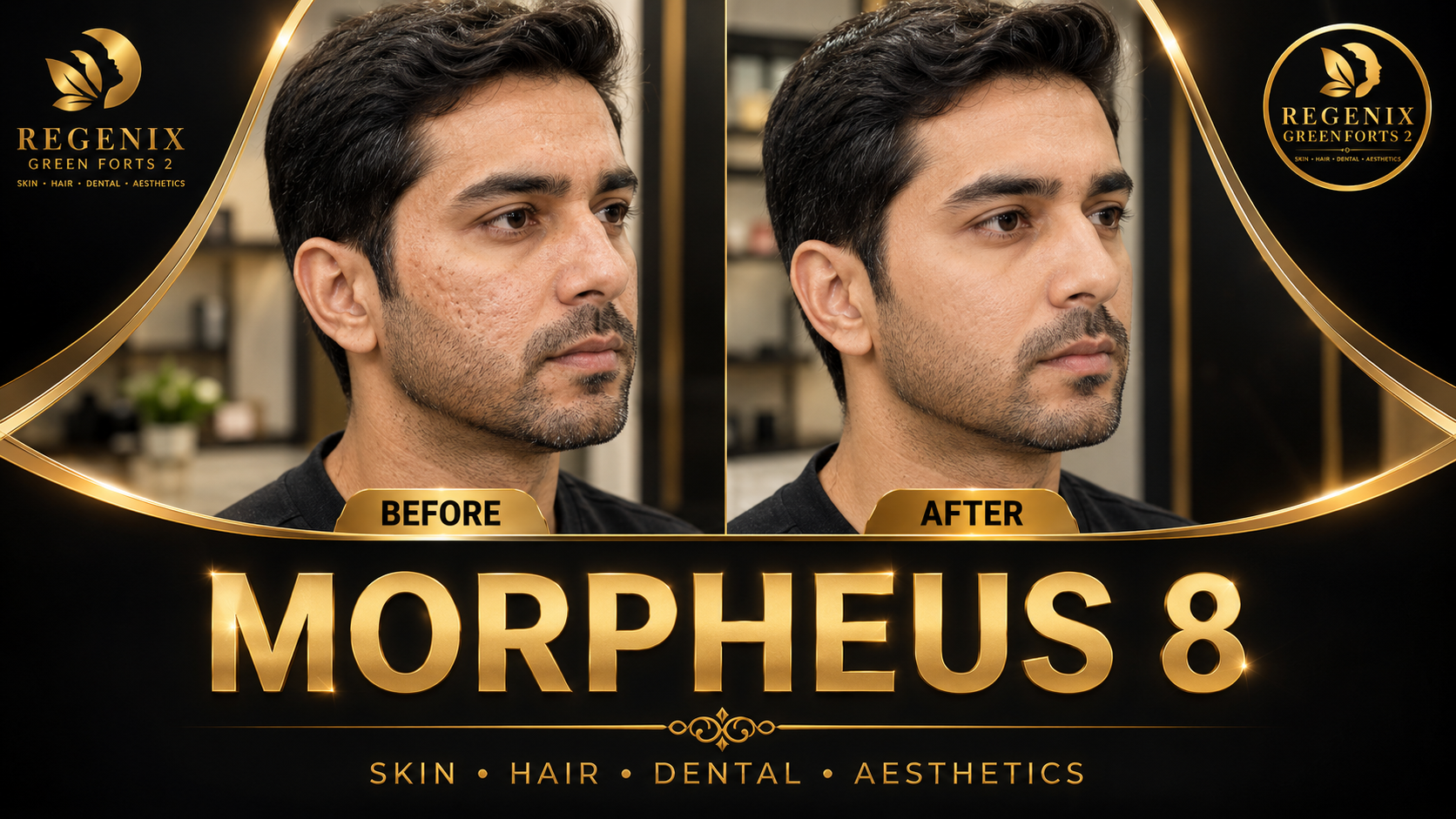 Morpheus 8 visual reference
