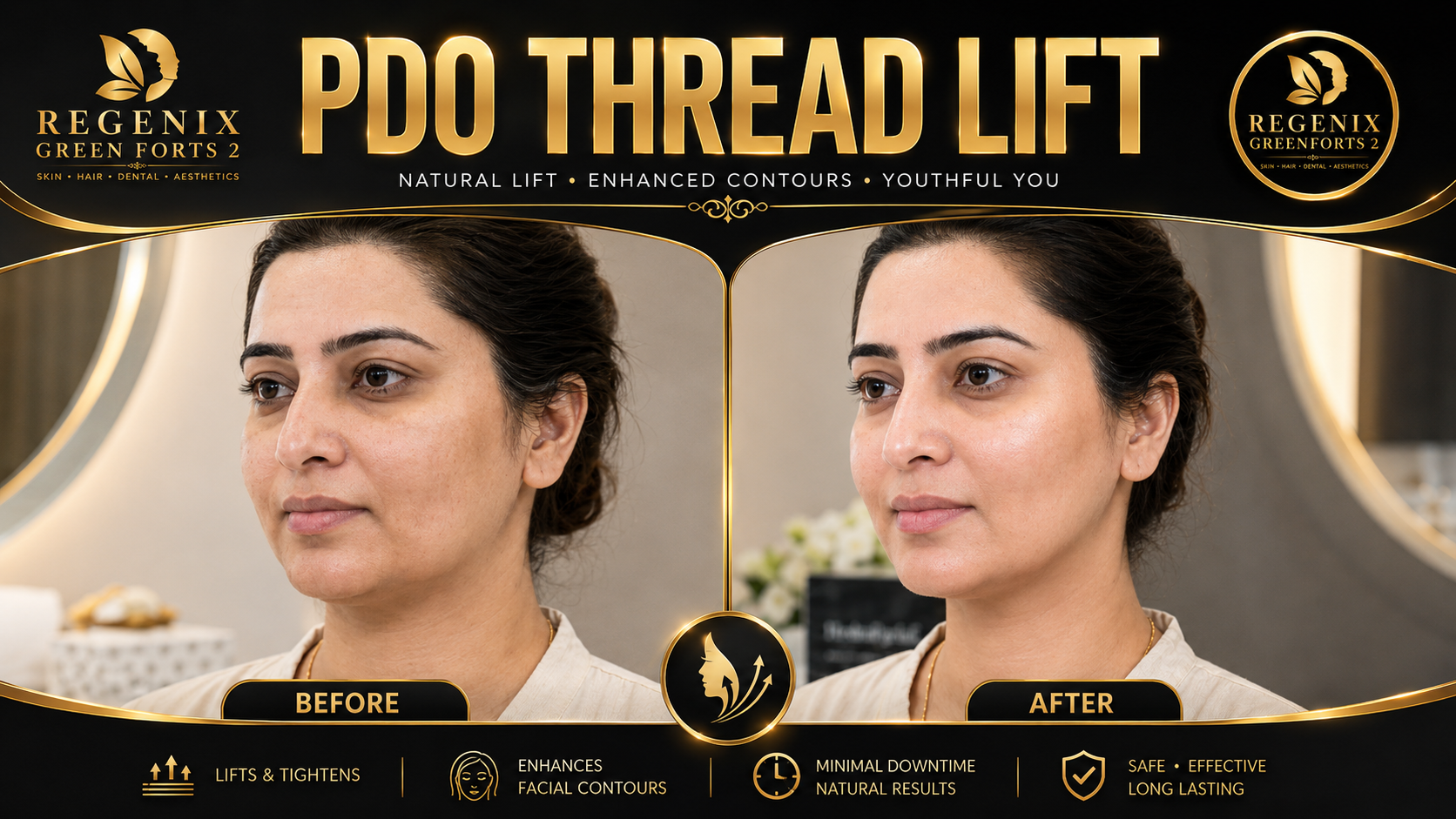 PDO Thread Lift visual reference