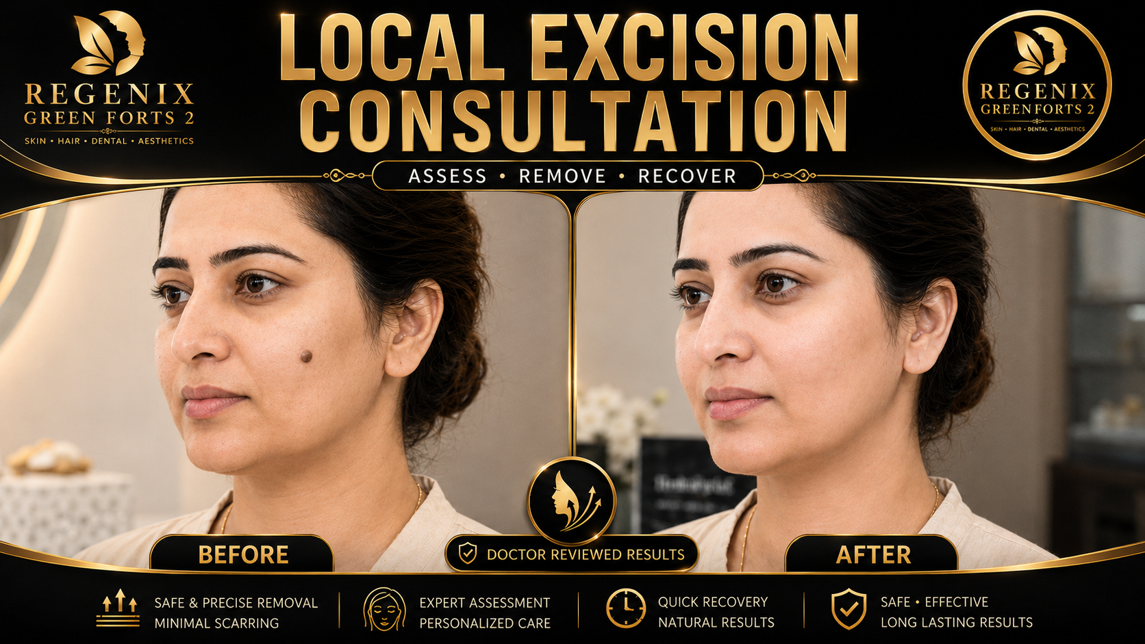 Local Excision Consultation visual reference