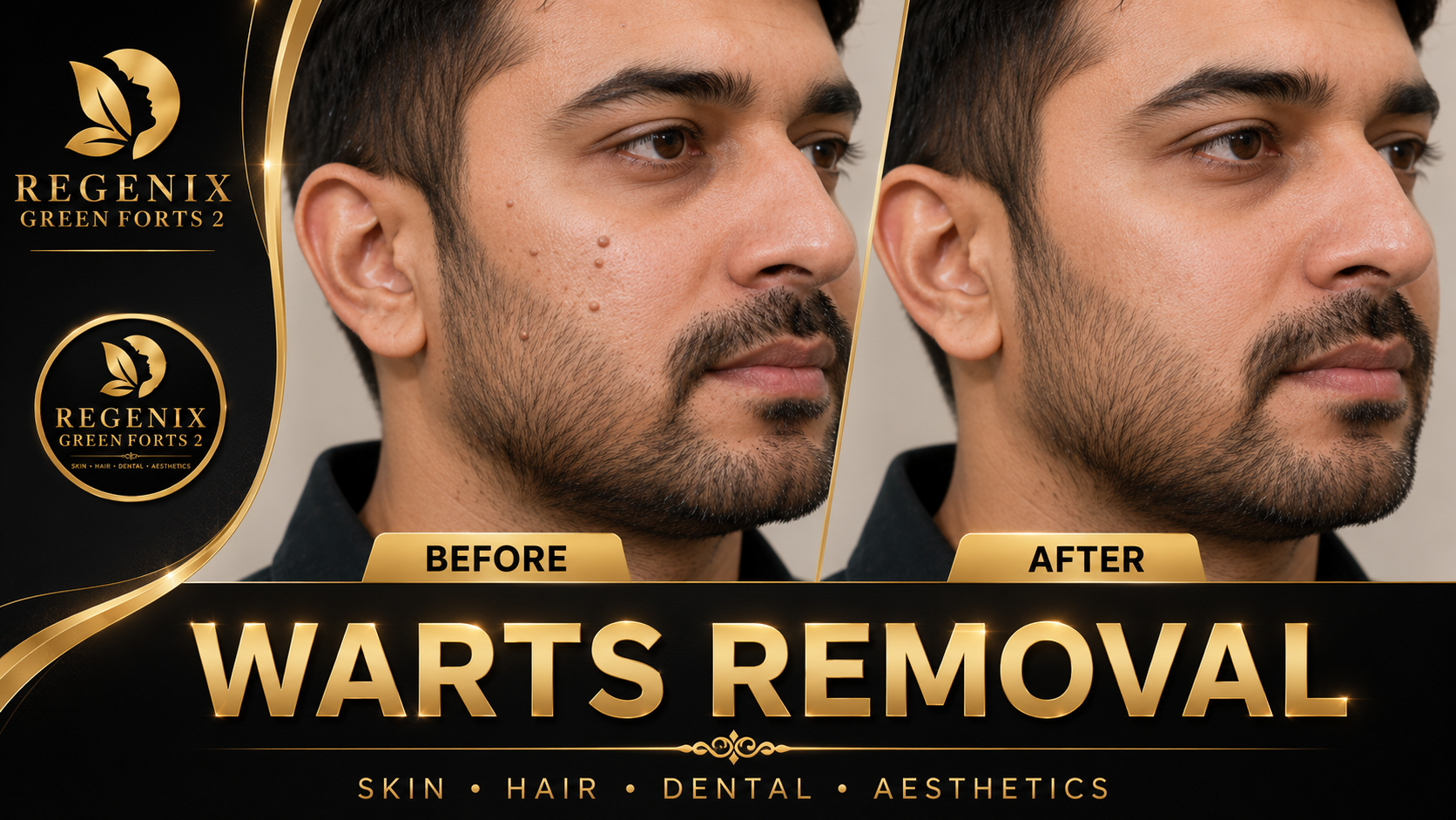 Warts Removal visual reference