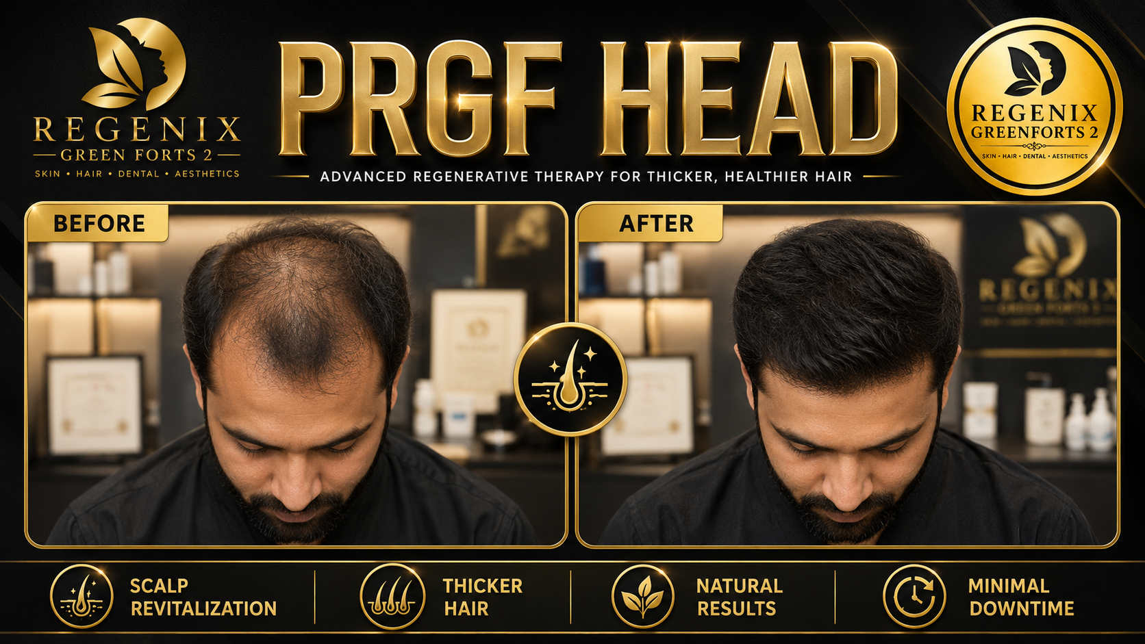 Hair Treatment at Regenix Greenforts 2