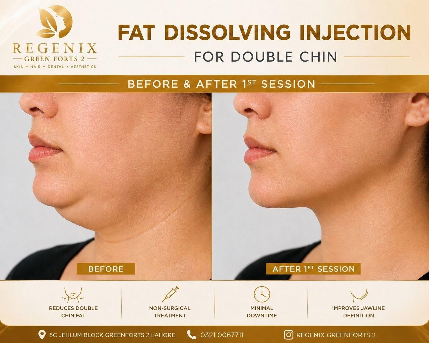 Fat Melting Injections visual reference