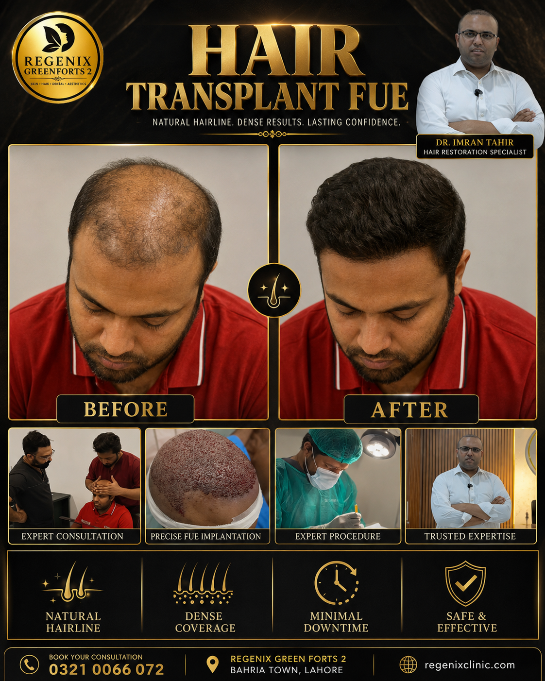 Hair Transplant FUE visual reference