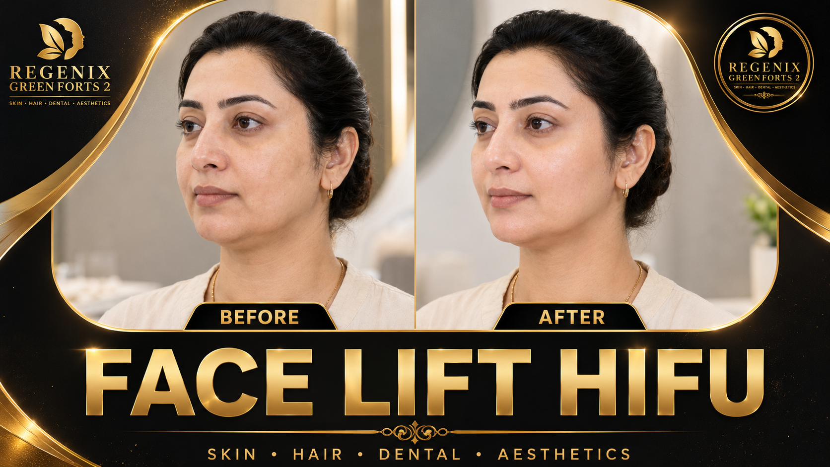 Face Lift HIFU visual reference