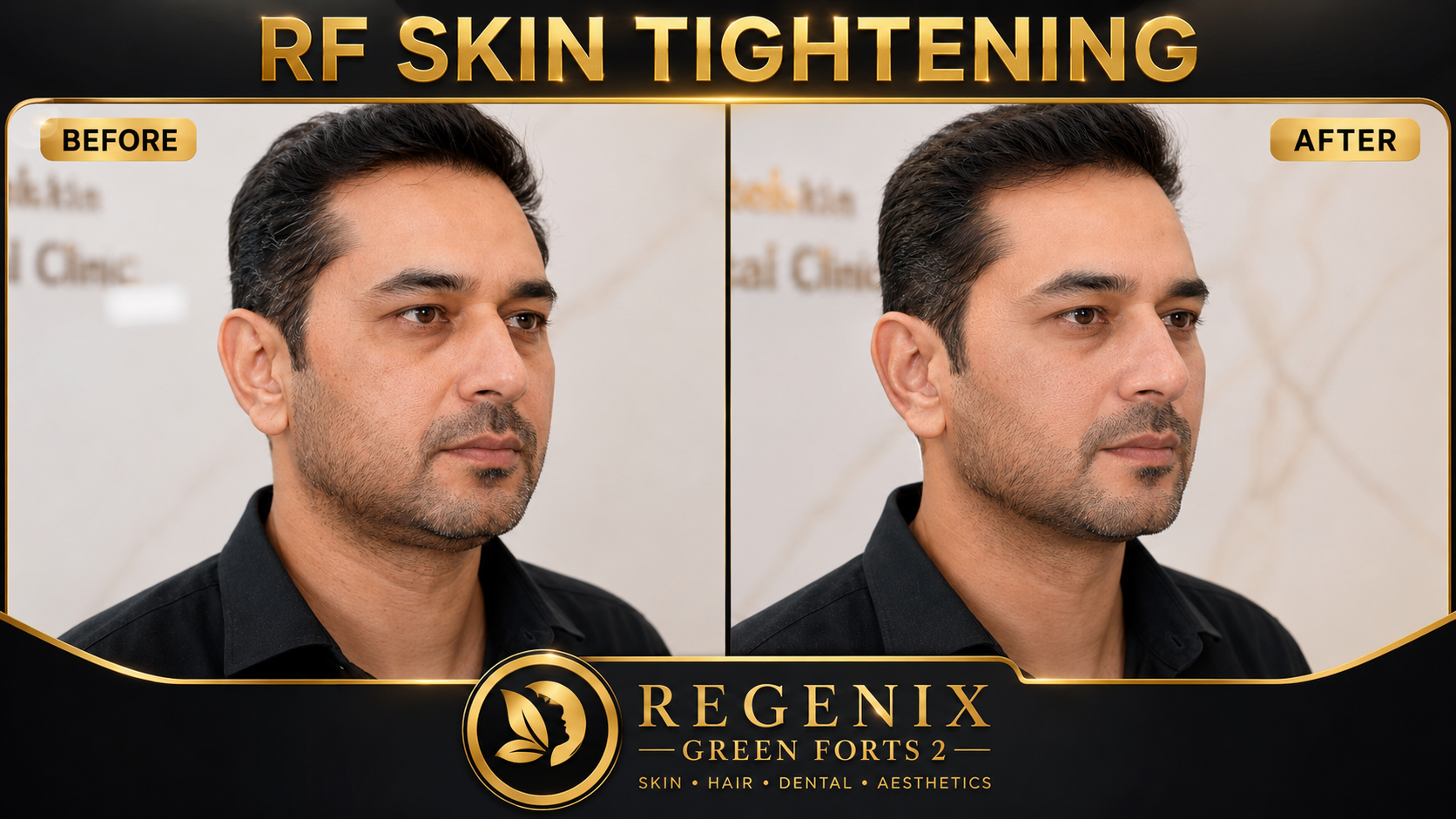 RF skin tightening