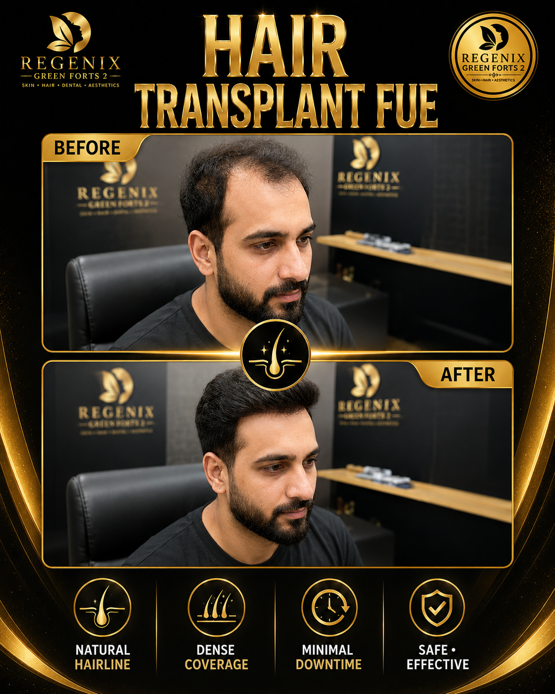 Hair Transplant FUE — Side Profile Result